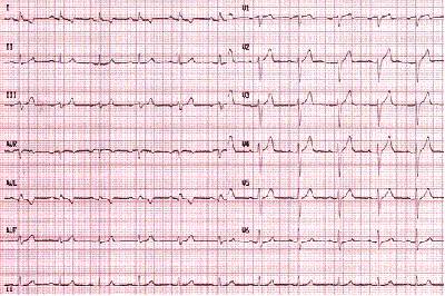 electrocardiograma-EKG