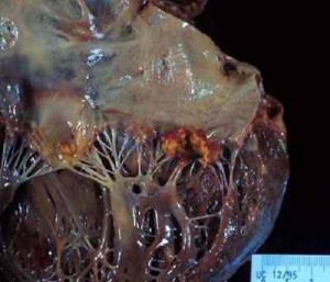 endocarditis-valvular-vegetacion