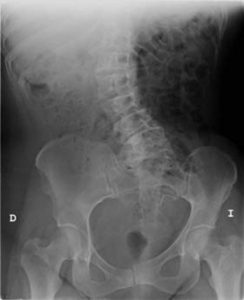 escoliosis-bomba-cobalto