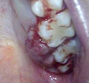 granuloma-piogenico-embarazo