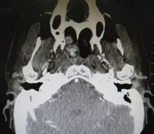 hemangioma-nasal-epistaxis
