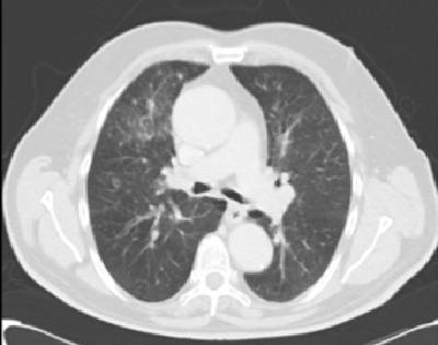 hemoptisis-cancer-papilar-tiroides