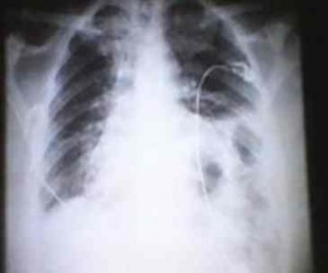 hernia-diafragmatica-congenita