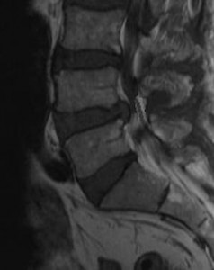 hernia-disco-lumbar-L4-L5