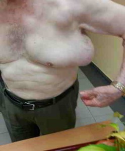 lipoma