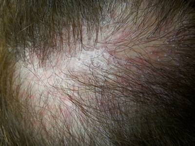 Liquen Plano Pilar Caso Clinico
