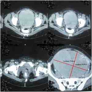 masa-abdominal-linfoma-no-Hodgkin