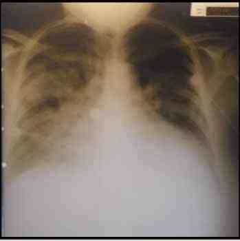 miocardiopatia-dilatada-periparto
