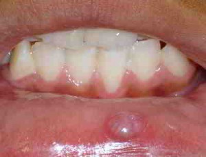 mucocele
