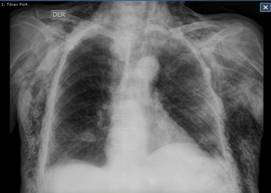 Radiografía de tórax en un paciente con enfermedad de Niemann Pick