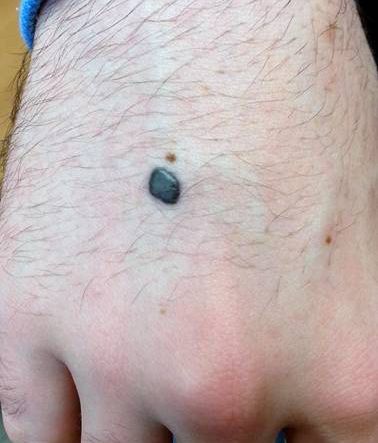 nevus-azul