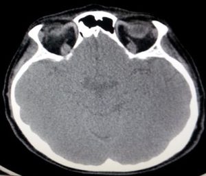 osteoma-craneal-tac