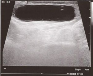 Ver Tabla nº 1: Ecografía: Colección anecoica, en canal inguinal izquierdo con unas dimensiones aproximadas de 3,7 x 1 cm compatible con quiste de cordón