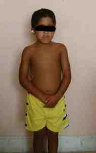sindrome-Noonan