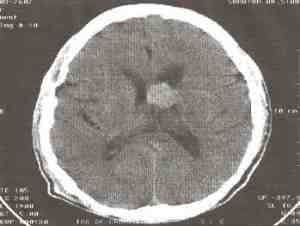 tumor-cerebro-TAC