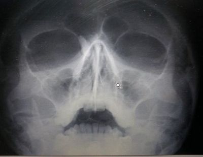 tumor-ojo-radiografia