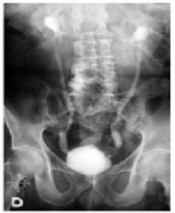 urografia-intravenosa